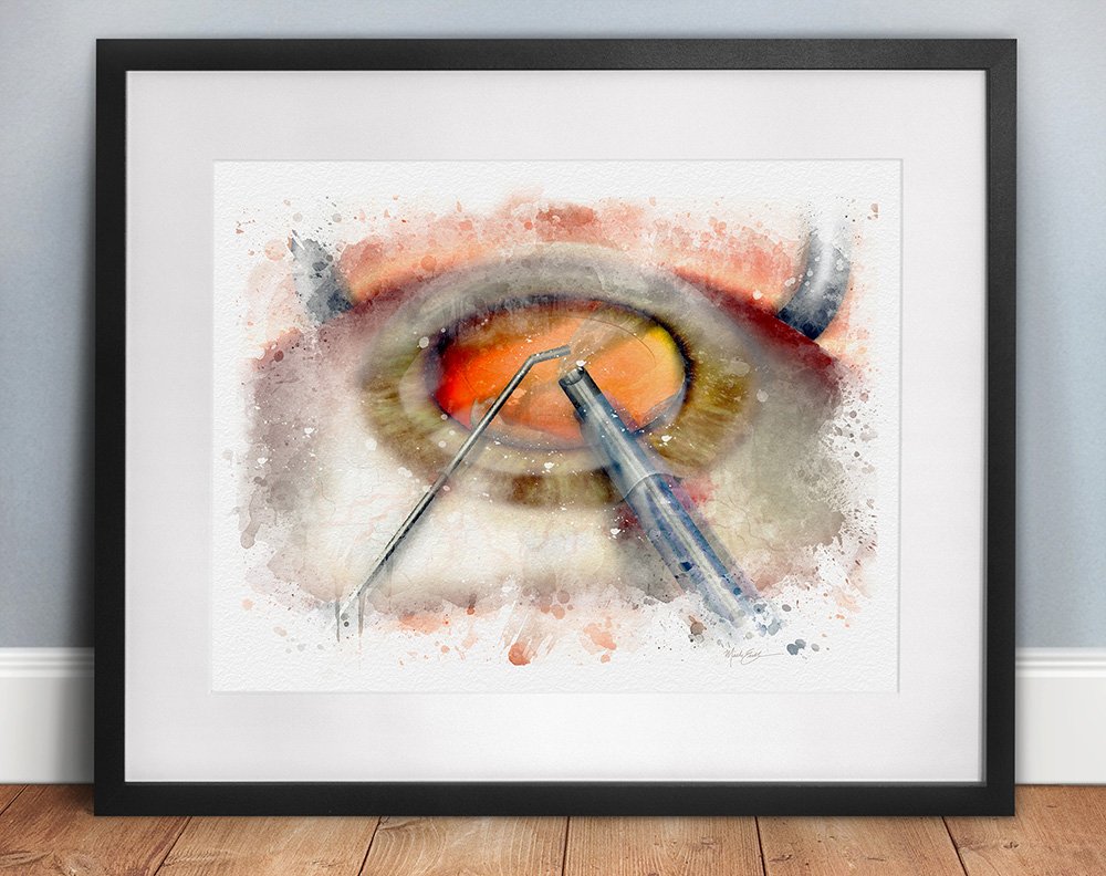 Cataract surgery decor, wall art for an ophthalmologist surgeon