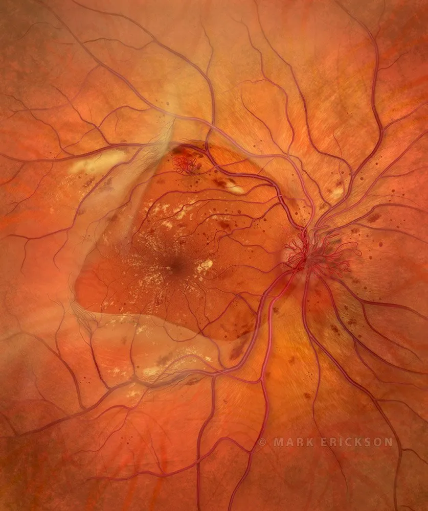 Proliferative Vitreoretinopathy Retinal Damage Illustration | CO3262 brvo PDR with proliferative vitreoretinopathy