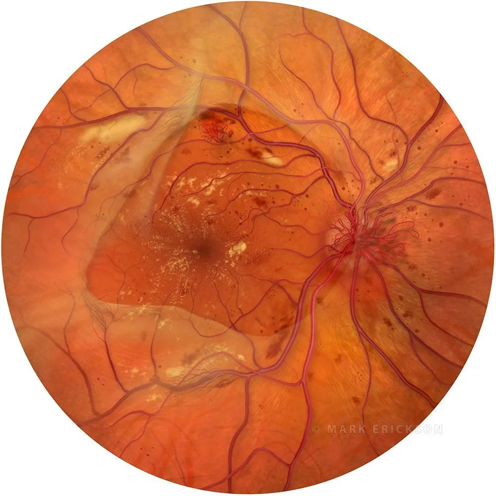 Proliferative diabetic retinopathy (PDR) fundus | co3262a brvo Advanced proliferative diabetic retinopathy