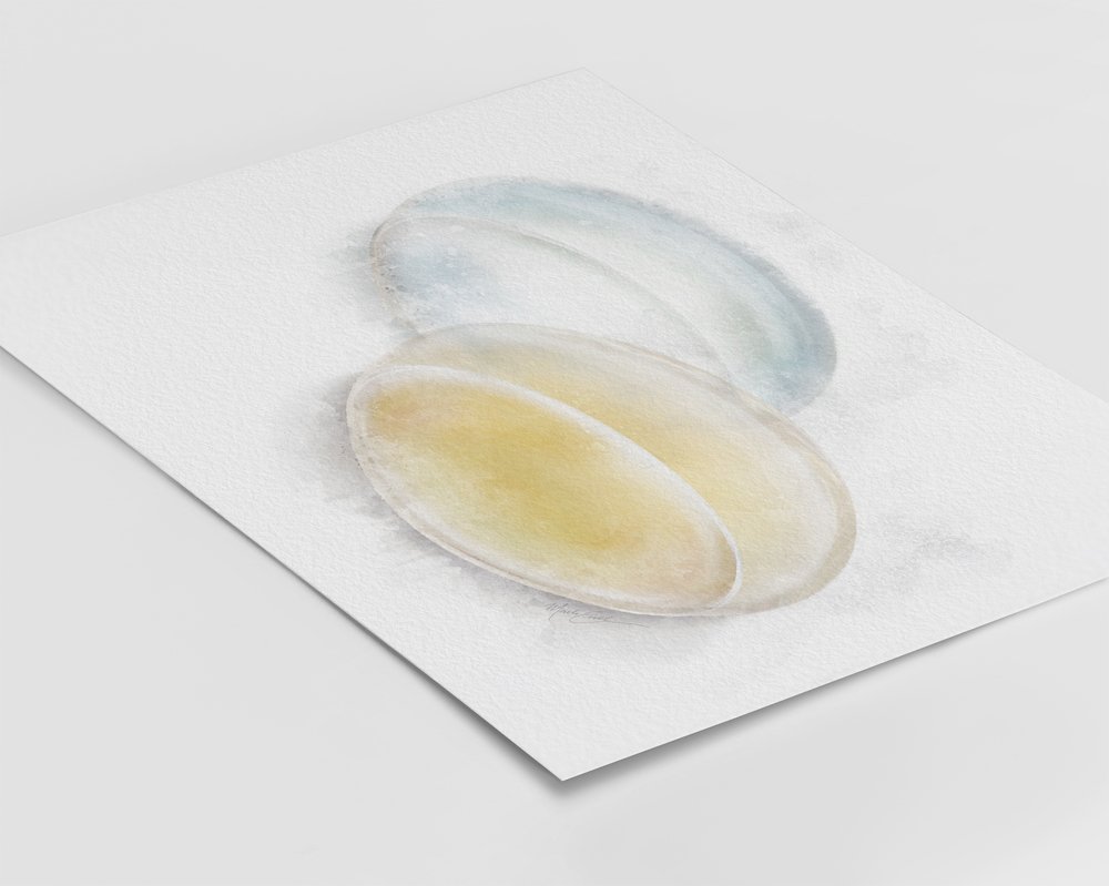 Cataract lens art illustrating intraocular lens comparison clearly - 034 cataract lens art Cataract wall decor