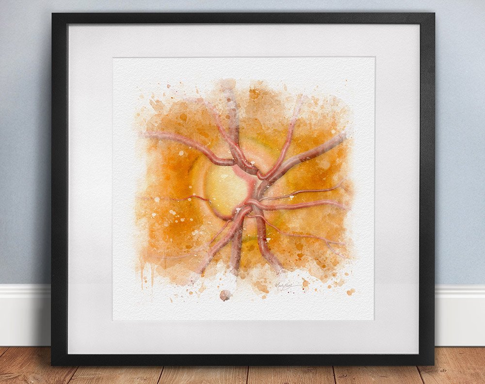 Glaucoma wall art for eye doctor's offices