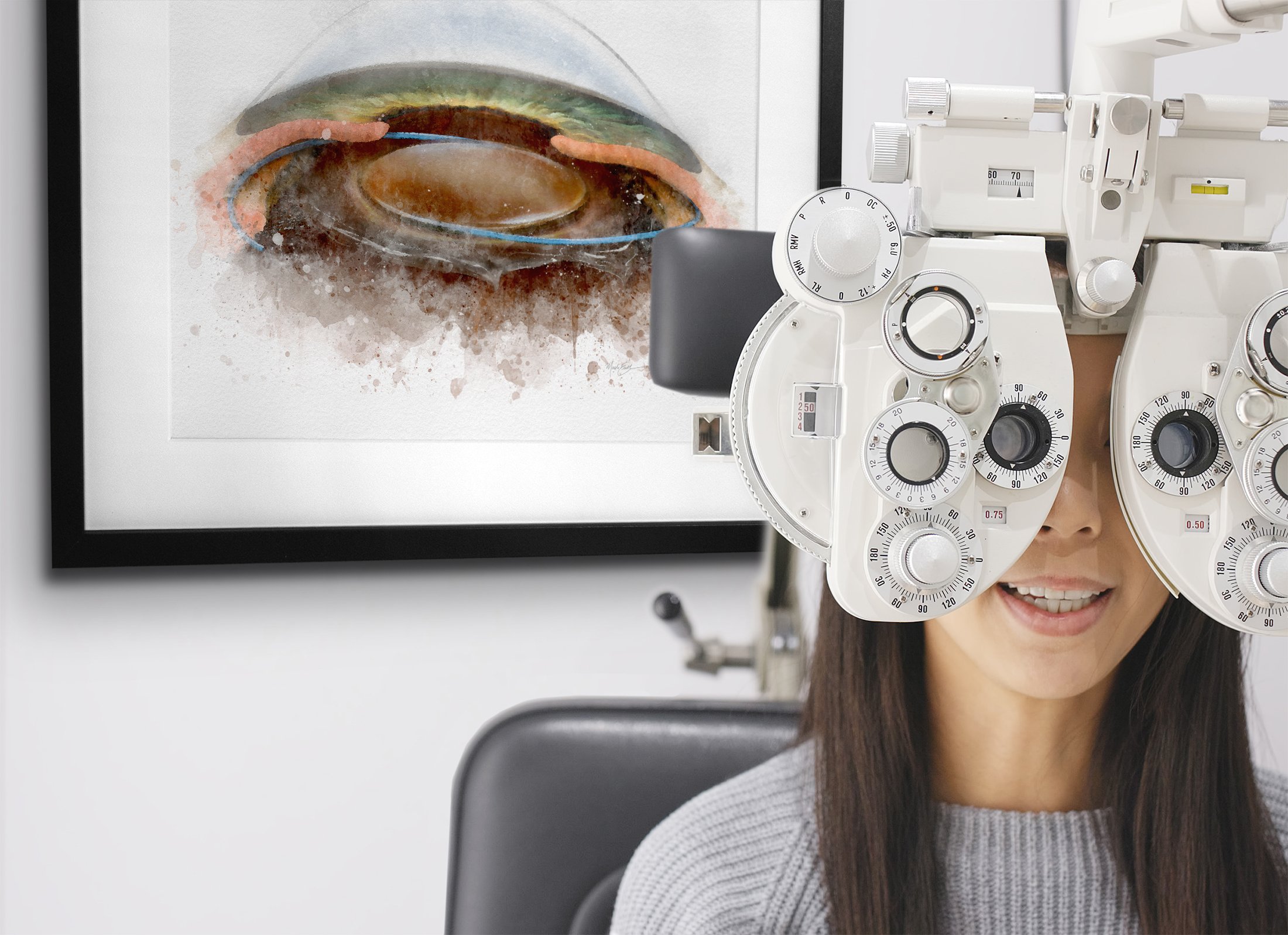 Sulcus IOL art print illustrating intraocular lens placement - 098 sulcus iol art IOL surgery wall art
