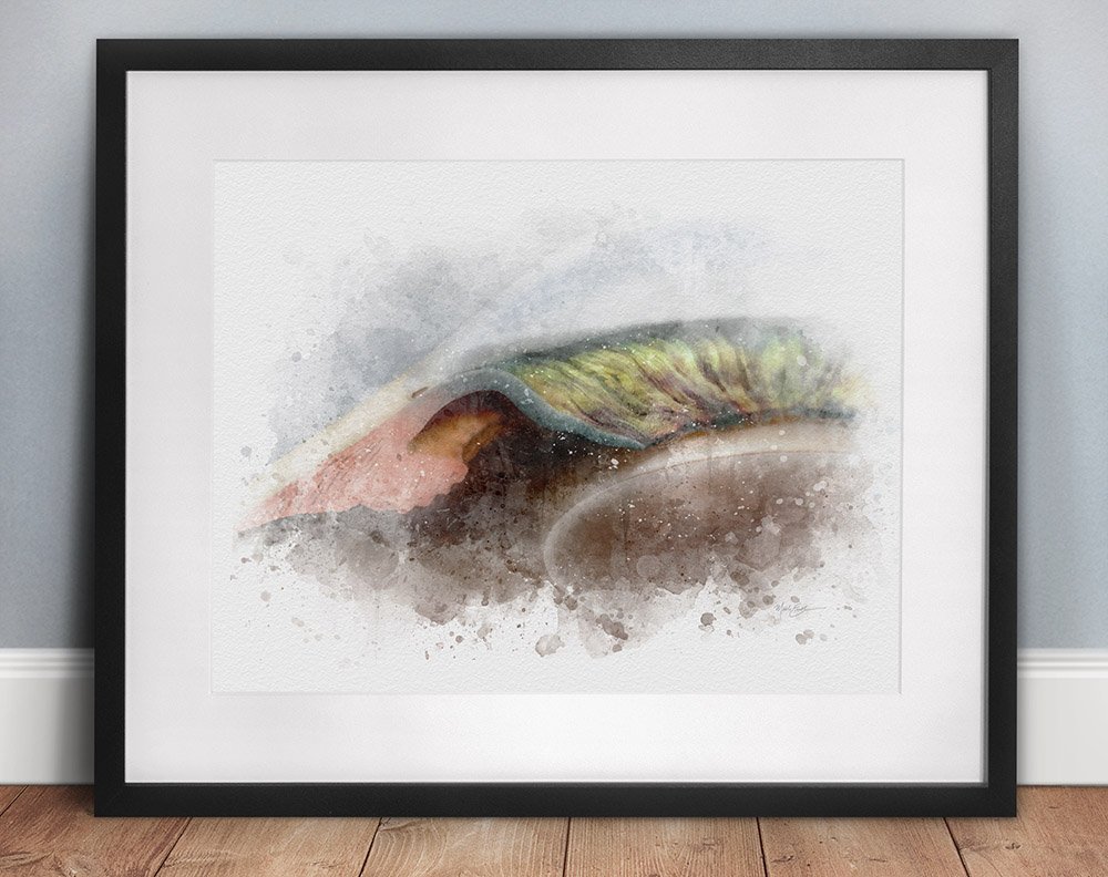 Closed angle glaucoma wall art print