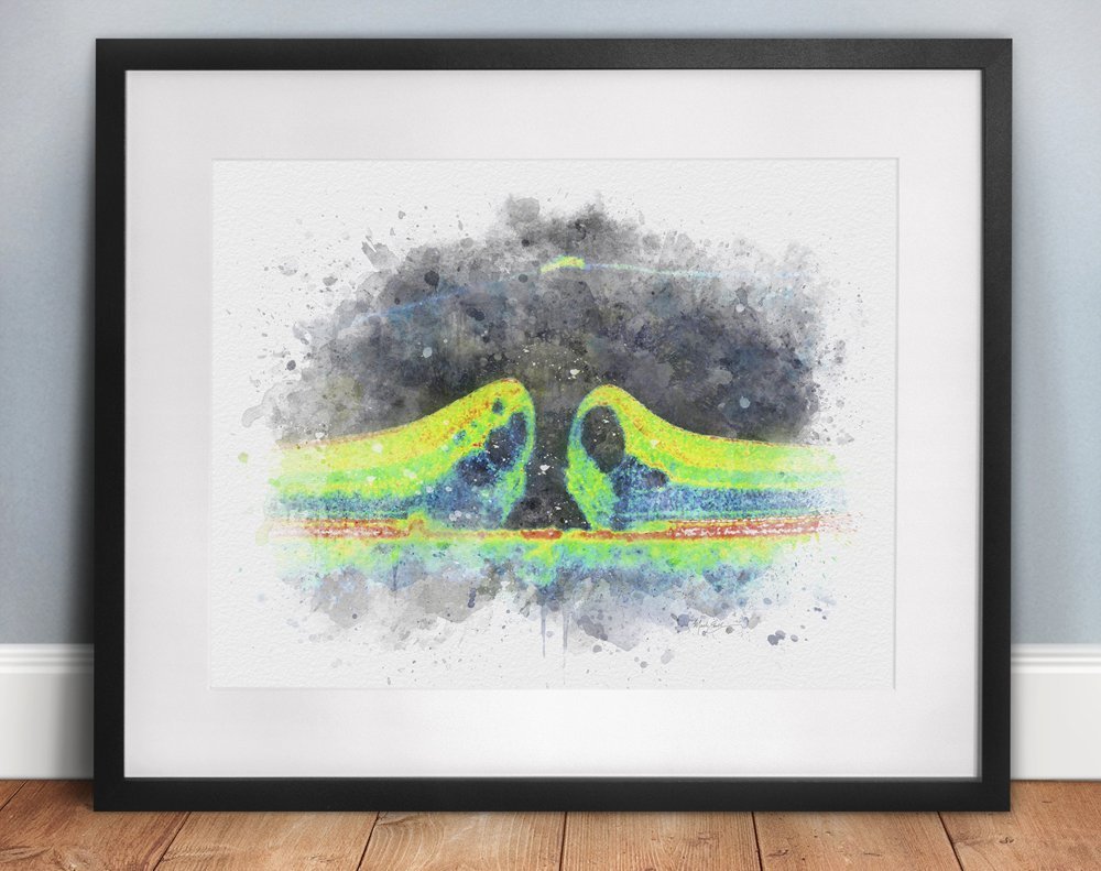 Macular hole optical coherence tomography art print