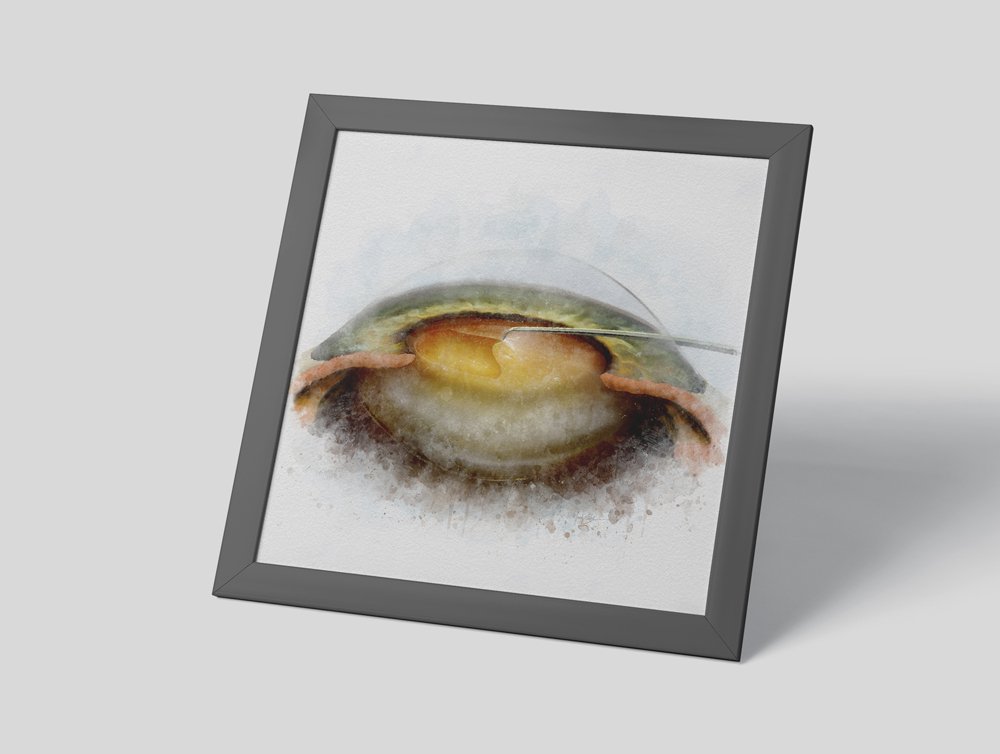 Capsulorhexis in cataract surgery wall art print - 030 capsulorhexis Capsulotomy art print