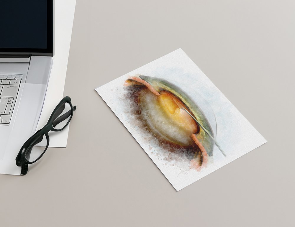 Capsulorhexis in cataract surgery wall art print - 030 capsulorhexis Cataract surgery art