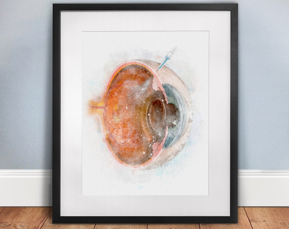 Eye injection wall art print