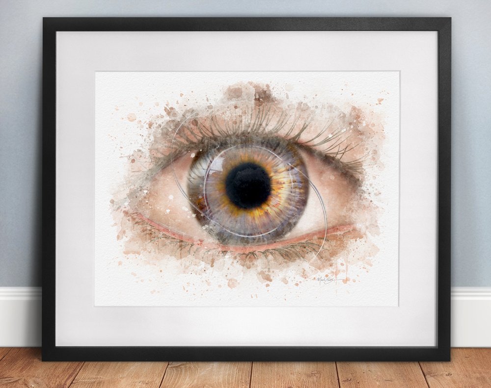 IOL art abstract wall art print eye doctor's office décor - 092 Cryoextraction IOL intraocular lens art print gift for an ophthalmologist