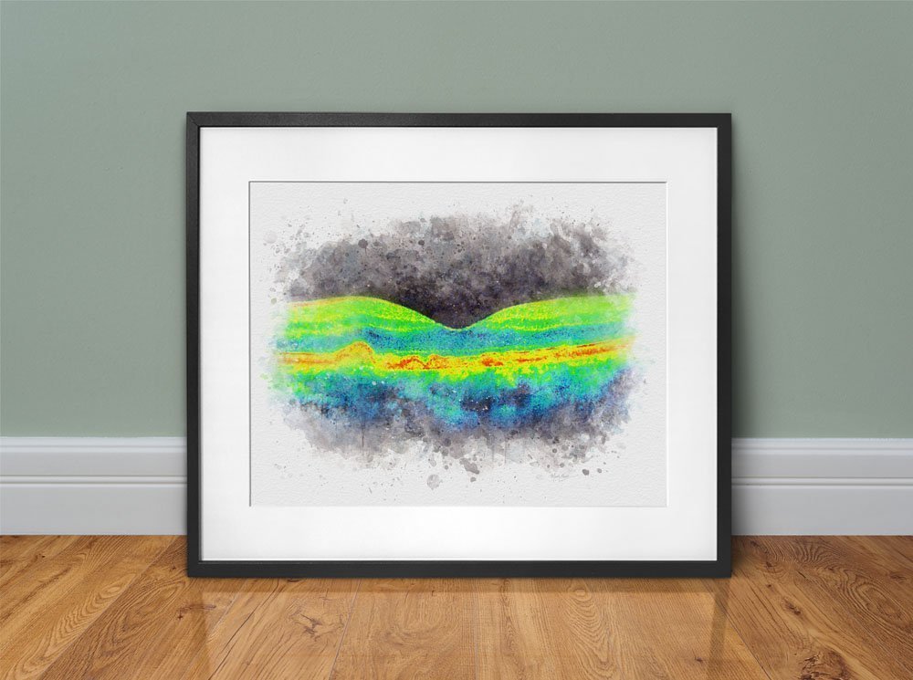 OCT drusen art print