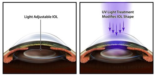 Light adjustable lens (LAL) illustration for premium IOL marketing