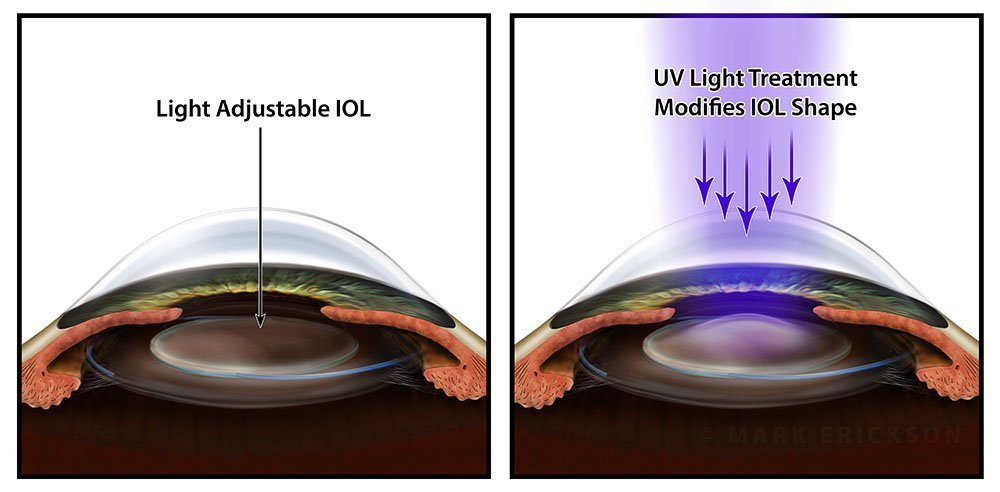 Light adjustable lens (LAL) illustration for premium IOL marketing