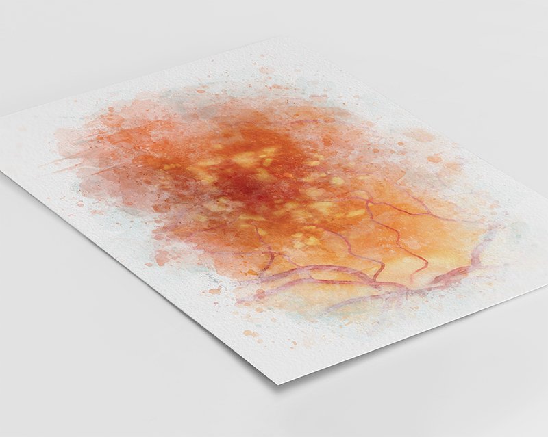 Drusen art print | retinal deposits in macular degeneration - 004 drusen art Macular degeneration art print