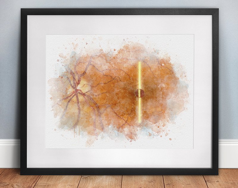 Macular hole exam art print