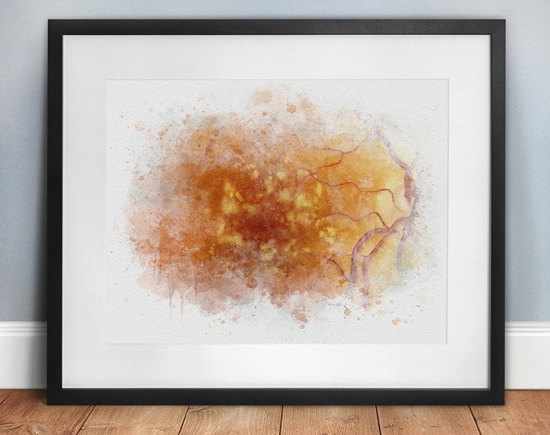 Drusen art print for eye doctors office