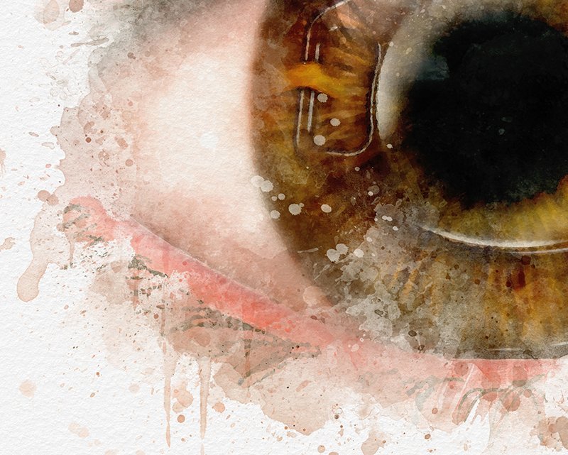 Iris fixated intraocular lens art print - 093 iris fixed iol Iris fixed intraocular lens art