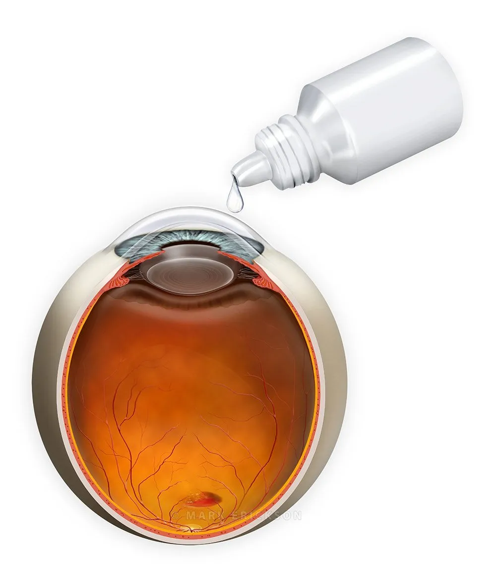 Eye drop for AMD - macular degeneration | suvr0019a brvo Eye drops that offer non-invasive AMD treatment alternative to injectable therapies for macular degeneration patients.