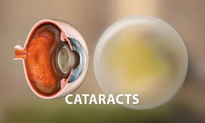 Cataracts explainer video for patient education