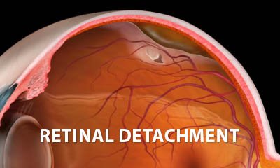 Retinal tear and detachment explainer video for patient education