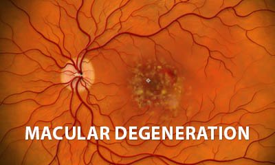 Macular degeneration patient education explainer video