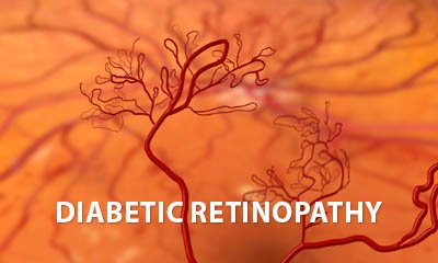 Diabetic retinopathy patient education explainer video download