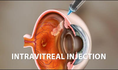 Intravitreal eye injection for macular degeneration and diabetic retinopathy