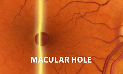 Macular hole slit lamp exam video clip