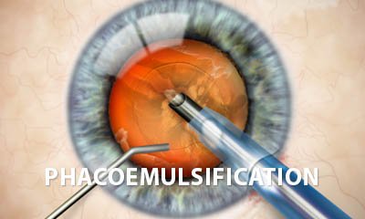 Phacoemulsification cataract surgery video clip