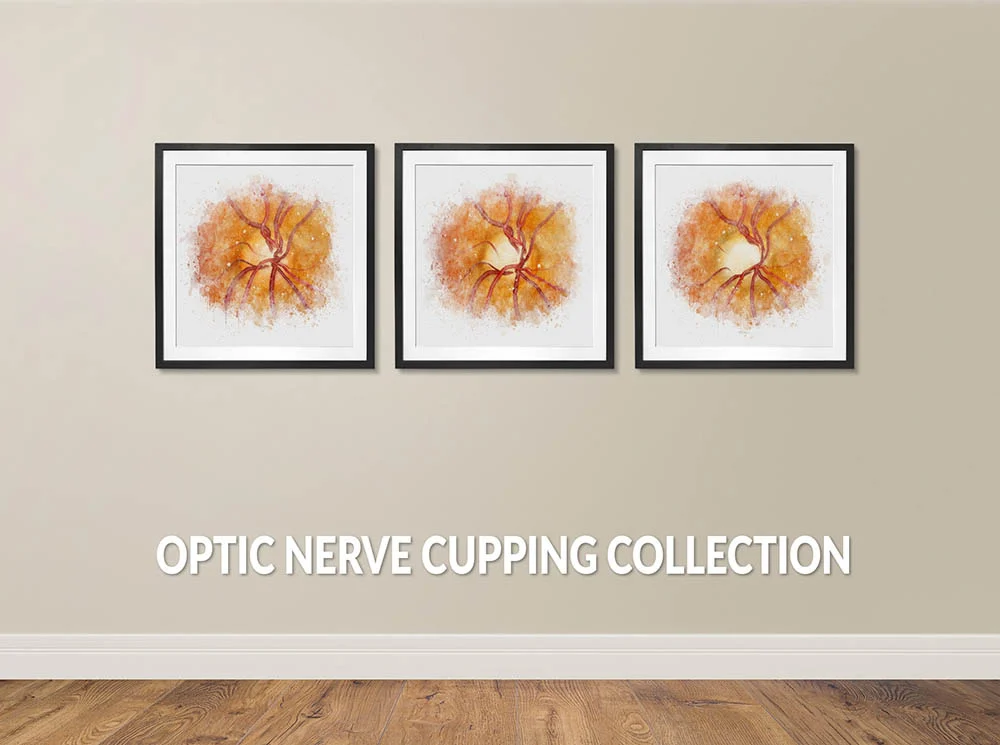 Optic nerve cupping in glaucoma wall art for an ophthalmologist